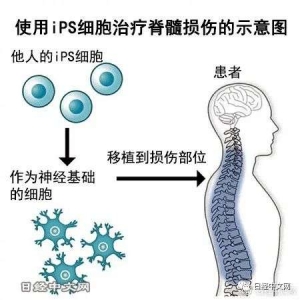 日本首次用iPS细胞治疗人类脊髓损伤